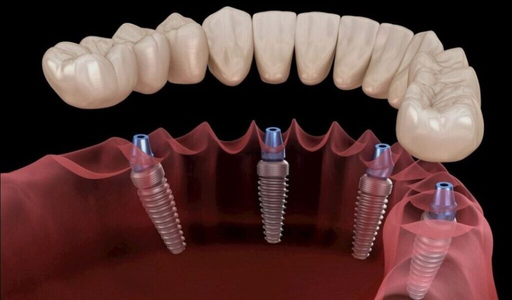 تركيب الأسنان ليس فقط للتجميل بل هو استثمار في العافية والثقة.. فما معرفتك به؟