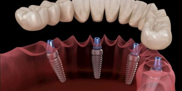 تركيب الأسنان ليس فقط للتجميل بل هو استثمار في العافية والثقة.. فما معرفتك به؟